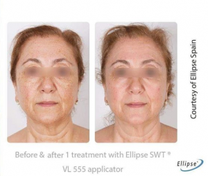 Ellipse Skin Rejuvenation 