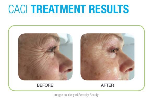 non-surgical treatment for anti-ageing